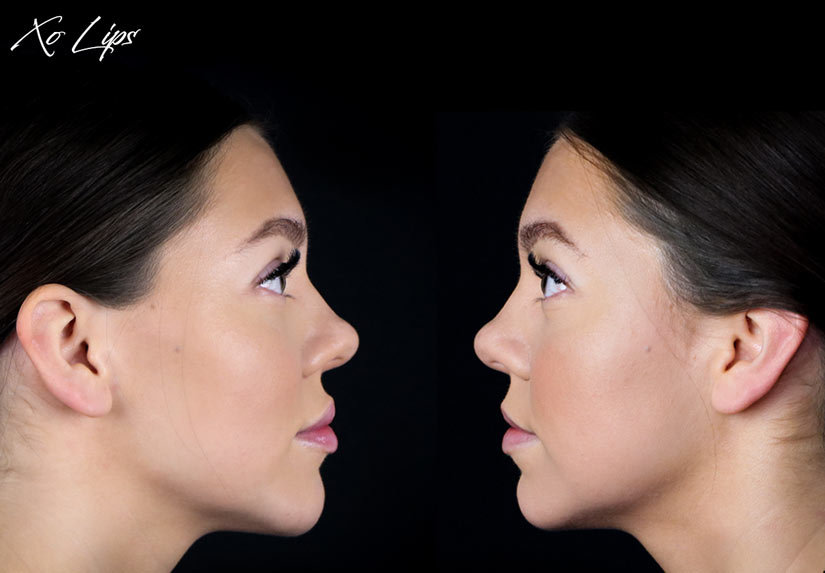 XO Lips Jönköping behandling läppar filler